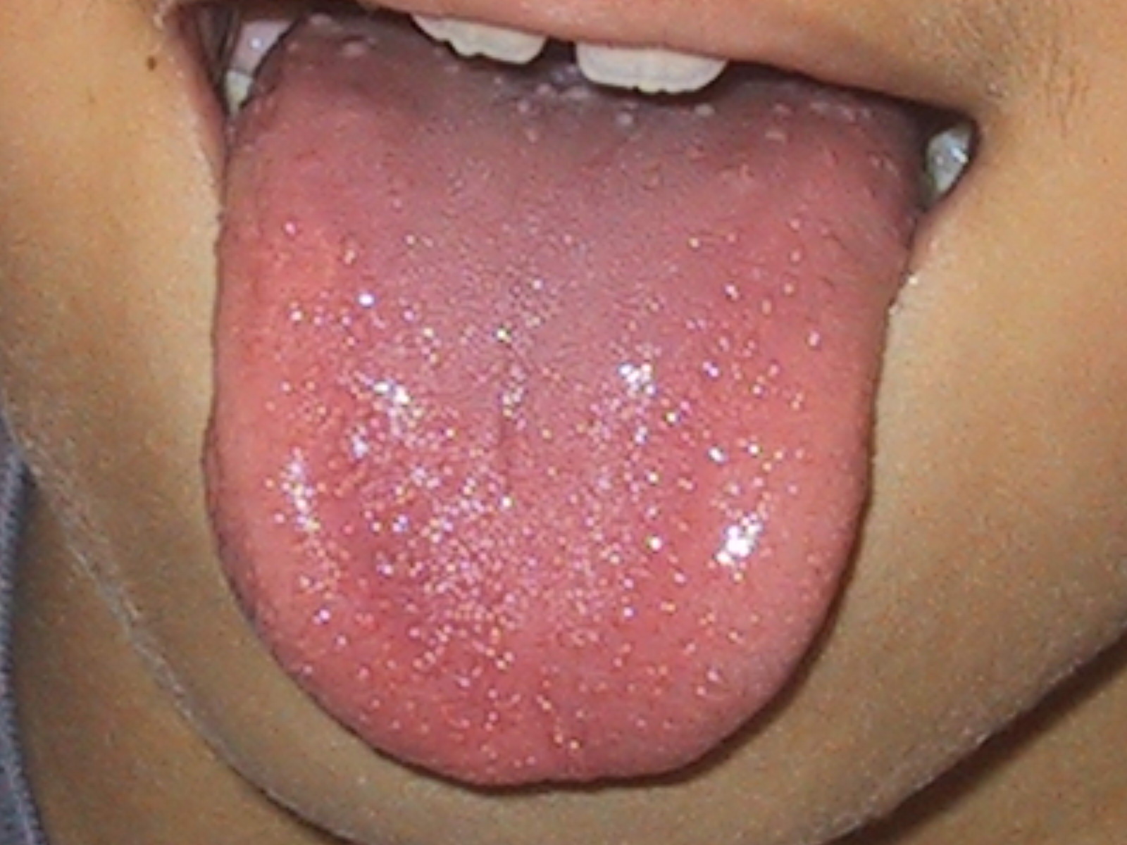 舌 溶連菌 いちご
